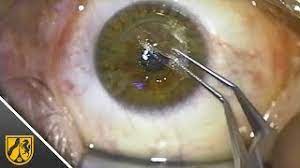 Augen Lasern In 26 Sekunden So Lauft Die Operation Mit Der Relex Smile Methode Youtube