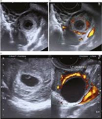Image result for corpus luteum sonography)