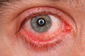 Bacterial keratitis is also often referred to as a 'corneal ulcer'. Bacterial Keratitis Vista Eye Care