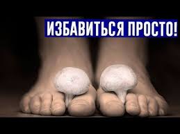 как избавиться от шрамов на ногах в домашних условиях Samyj Silnyj Gribok Ujdet Navsegda Esli Na Noch Derzhat Nogi V Goryachej Youtube Nel 2020