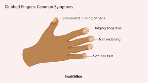 Image result for Clubbing nails feet