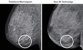 American cancer society, 9 oct 2017. 3d Mammography Tm Medical Associates Of Northwest Arkansas