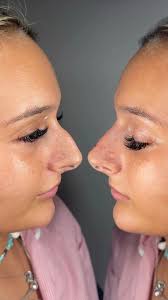 1.1ml Advanced/Russian Lips 🤍