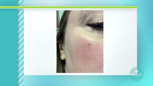 If you think chewing tobacco is a healthier alternative to smoking, think again. Skin Cancer Screenings Drop Dramatically During Pandemic Wfla