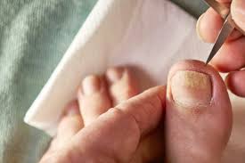 Image result for Pitting nails feet