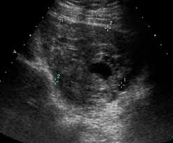 Image result for corpus luteum sonography)