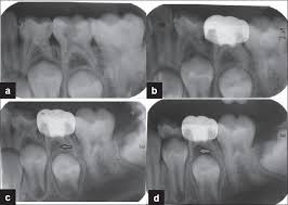 Pin By Lorrelei Paires On Xrays Dental Hygenist Dental Videos Dental Kids