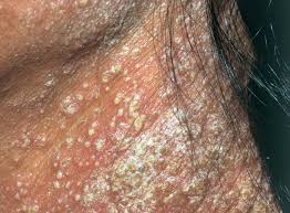 Image result for PSORIASIS