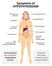 Hypothyroidism Most Common Hair Loss Cause In Women Hypothyroidism Symptoms Hypothyroidism Natural Treatment Thyroid Symptoms