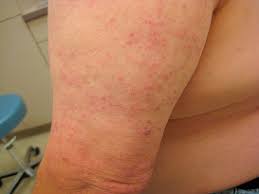 Aitl is generally a rapidly progressive disease. Evaluation Of Cutaneous Angioimmunoblastic T Cell Lymphoma Journal Of The American Academy Of Dermatology