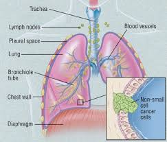 Lung cancer is sometimes also called pulmonary cancer. Adenocarcinoma Of The Lung Guide Causes Symptoms And Treatment Options