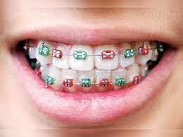 Fake Braces Fad Can Be Dangerous Times Of India