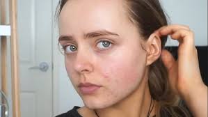 We did not find results for: Why Am I Having A Breakout What The Position Of Your Spots Say About Your Health Daily Mail Online