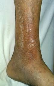 Image result for dermatitis contacta allergica