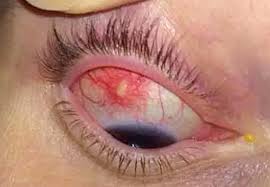 Image result for Scleritis