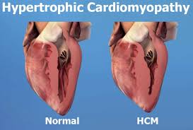 Image result for Cardiomyopathy