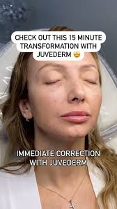 Jawline goals in just 15 minutes ✨, This beautiful client came in concerned  about her jowls, marionette lines, and nasolabial folds. With just one  syringe of Juvederm—strategically and precisely ...