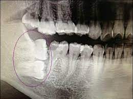 Here Is A Double Horizontal Impacted Wisdom Tooth 32 Along With And The 2nd Molar 31 Notice How The Back Of The 1st Molar 3 Dental Dental Facts Dental Life