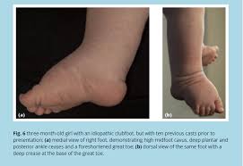 Image result for Clubfoot