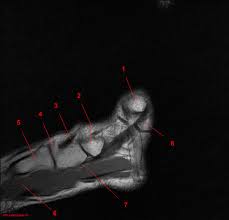 Learn about innervation anatomy foot muscles with free interactive flashcards. Mrt Der Fussgelenk Anatomie