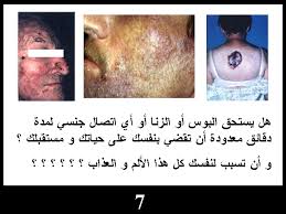 صور عن مرض الايدز 4