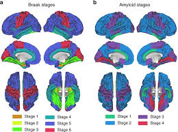 Start with the 4 a's. Alzheimer Forscher Kommen Verbreitetem Risikotyp Auf Die Spur Healthcare In Europe Com