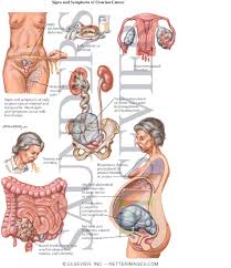 The exact cause of ovarian cancer is unknown, but certain things are thought to increase a woman's risk of developing the condition, such as age, the number of eggs the ovaries release and whether someone in your family. Signs And Symptoms Of Ovarian Cancer