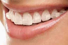 However, if you have too many stains, you may need tooth whitening treatment after braces. How To Stop Or Prevent Ceramic Braces From Staining