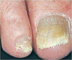 We did not find results for: Why Our Toenails Thicken As We Age