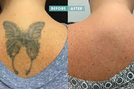 The pain, the smell, the experience, the relationship with the artist and the beauty afterward are all part of the process. Tattoo Removal Business To Set Up Shop In Ballston Arlnow Com
