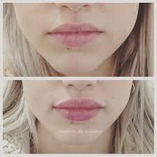 Pin On Lip Fillers