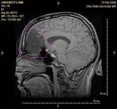 Possible risks of a pet scan. Cancer Detection With Mri As Effective As Pet Ct Scan But With Zero Radiation Risks