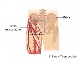 It is often referred to as a 'pulled groin muscle', or a 'groin pull' and can range from a mild to very severe. Groin Pulled Strained Information Sinew Therapeutics