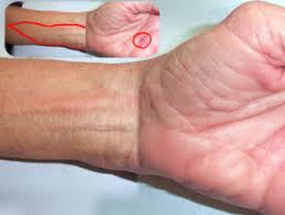 If fever goes to 101 or above and persists then your wound is infected and you must go for doctor. Wound Infection Dermnet Nz