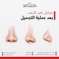 مراحل تغير الأنف بعد عملية التجميل بالصور لمتابعة نتائج الجراحة بشكل دقيق