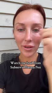 Stomach laxity? Subnovii's got you covered! ⚡️ Huge thanks to  @peakmedicalspa for showcasing how Subnovii Plasma Pen can help tighten  wrinkles and sagging skin