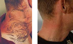 These guys are going to find out and explain it to us. How Does Laser Tattoo Removal Work