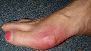 Image result for gout