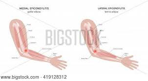 Muscles that need a lot of strength to perform their function—like leg or arm muscles—have many muscle cells in each motor unit. Pain Human Arm Vector Photo Free Trial Bigstock