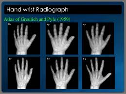 skeletal age assessment