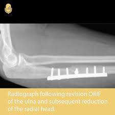 Image result for Radial Head Dislocation