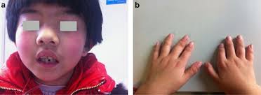 Exome sequencing identifies a de novo mutation in HDAC8 associated with  Cornelia de Lange syndrome