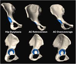 Image result for Femoral Retroversion