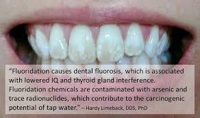 Dental Fluorosis In Australia Fluoride Free Australia