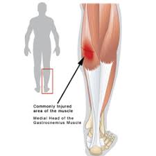 How To Treat A Herniated Calf Muscle