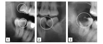 Lagi pun gigi tu dah pernah malas nak simpan gigi macam tu. Pencabutan Gigi Bungsu The Implant And Oral Surgery Centre