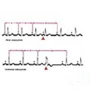 Image result for Extrasystole