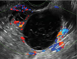 Therefore, different examination methods can be selected in clinic according to the different situations. Telltale Sonographic Features Of Simple And Hemorrhagic Cysts Mdedge Obgyn
