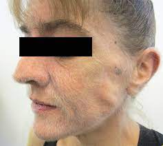 Hereditary hair loss with age is the some conditions and medical treatments, such as chemotherapy for cancer, can result in the loss of medications and supplements. Excessive Hair Growth A Sign Of Cancer Medizzy Journal