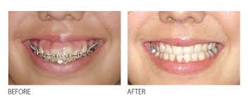 Your cosmetic dentist will aim to balance out the size of your teeth with your gums. Fixing A Gummy Smile Can Be Easier Than You Think Firstbite Dental Essendon Dentist